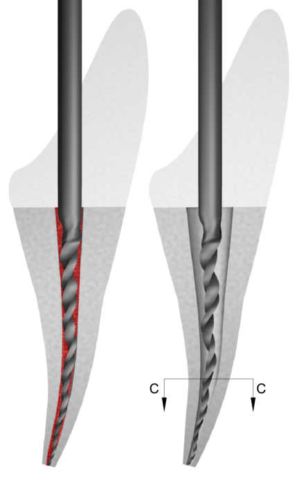  Instrument to Engage the Root Canal Space A